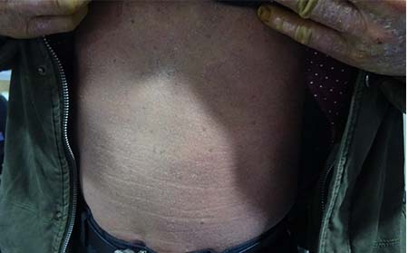 牛皮癬癥狀,牛皮癬癥狀特點