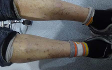 兒童牛皮癬癥狀,兒童牛皮癬癥狀特征