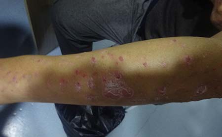 兒童銀屑病常識,兒童銀屑病特點