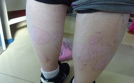 兒童銀屑病癥狀,兒童銀屑病發病癥狀