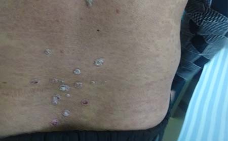 消退期銀屑病癥狀,銀屑病消退期癥狀