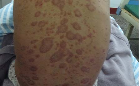 男性牛皮癬癥狀,男性牛皮癬癥狀特征