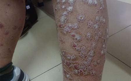 腿部銀屑病病因,腿部為什么長銀屑病