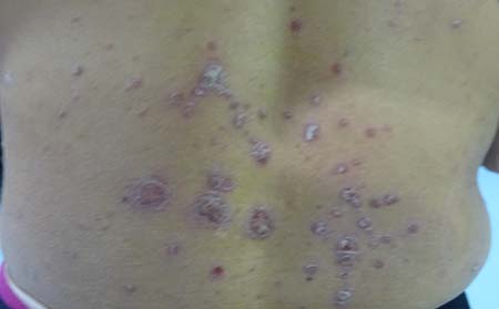 銀屑病癥狀表現(xiàn),銀屑病癥狀特征