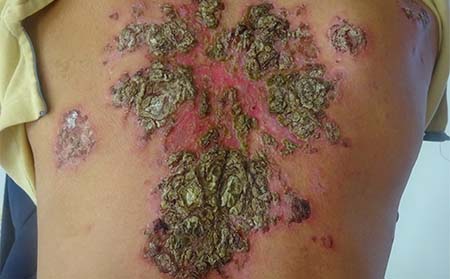 膿皰型銀屑病癥狀,膿皰型銀屑病臨床表現