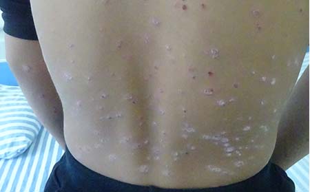 牛皮癬初期怎樣控制,初期牛皮癬怎樣預防