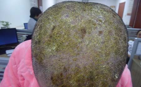 頭部銀屑病癥狀,頭上長銀屑病什么樣