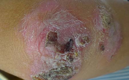 膿皰型牛皮癬癥狀,膿皰型牛皮癬臨床圖片