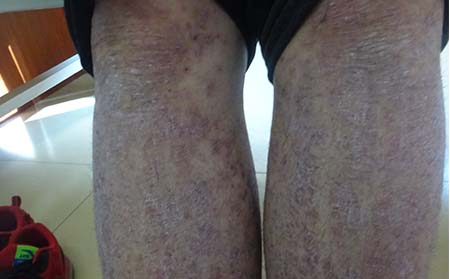 兒童牛皮癬癥狀,兒童牛皮癬癥狀表現(xiàn)