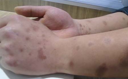 點滴型銀屑病癥狀,點滴狀銀屑病特征