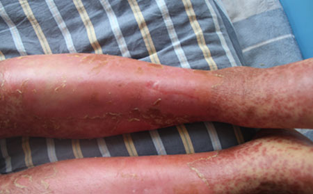 紅皮型銀屑病癥狀,紅皮型銀屑病圖片表現