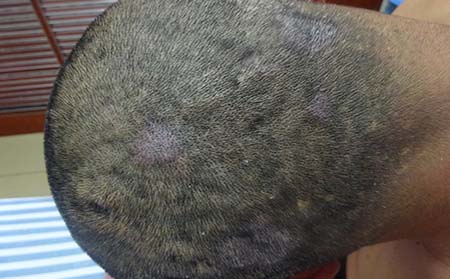 牛皮癬初期癥狀,牛皮癬初期癥狀表現