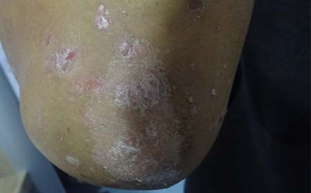 銀屑病好轉癥狀,銀屑病快好癥狀表現