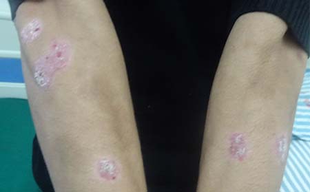 牛皮癬常識,牛皮癬相關常識