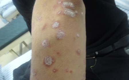 牛皮癬初期癥狀,牛皮癬初期癥狀圖片