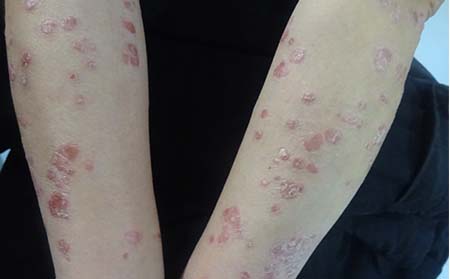 兒童牛皮癬癥狀,兒童牛皮癬早期癥狀