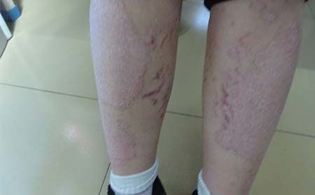 女性牛皮癬癥狀,女性患牛皮癬癥狀表現