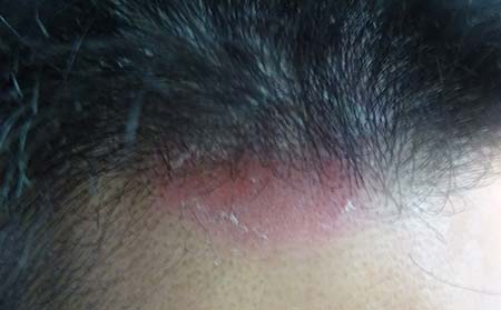 頭部銀屑病傳染,怎樣避免銀屑病傳染