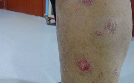 尋常型銀屑病癥狀,尋常型銀屑病癥狀圖片