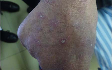 銀屑病初期癥狀,銀屑病早期癥狀表現(xiàn)