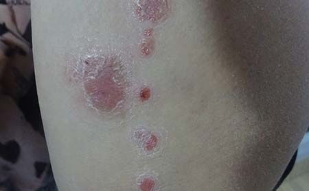 兒童牛皮癬癥狀,兒童患牛皮癬癥狀