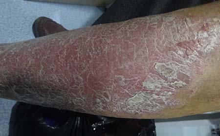 銀屑病常見癥狀,銀屑病有什么癥狀