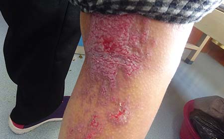 腿部銀屑病癥狀,腿部銀屑病癥狀圖片