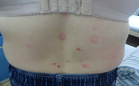 尋常型銀屑病癥狀,尋常型銀屑病表現