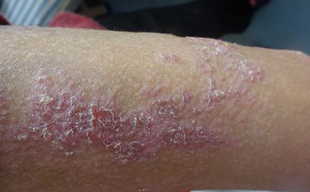 牛皮癬癥狀表現(xiàn),得牛皮癬癥狀表現(xiàn)