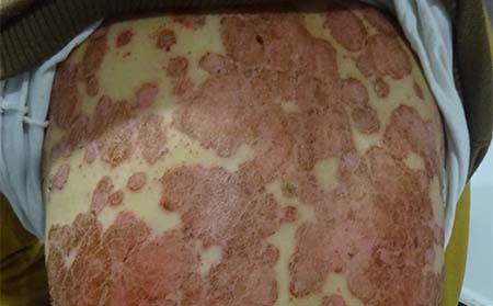 紅皮型牛皮癬癥狀,紅皮型牛皮癬初期癥狀