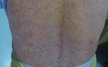 銀屑病癥狀,銀屑病初期癥狀表現