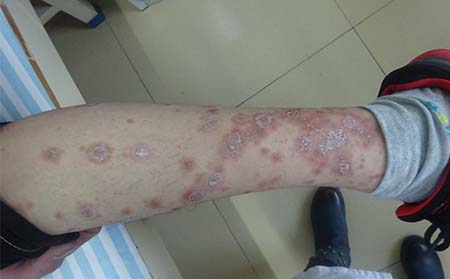 兒童牛皮癬癥狀,兒童牛皮癬表現癥狀