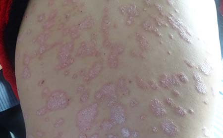 皮膚牛皮癬癥狀,牛皮癬皮膚癥狀表現