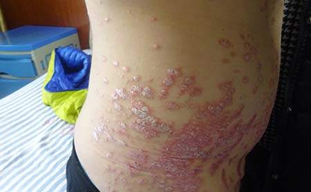 牛皮癬癥狀表現,牛皮癬早期癥狀表現