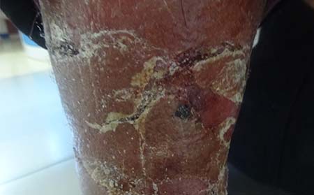 紅皮型銀屑病癥狀,紅皮型銀屑病圖片