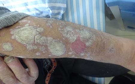 銀屑病癥狀特征,得銀屑病癥狀什么樣