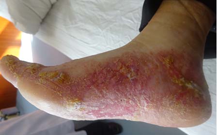 腳部銀屑病病因,腳上銀屑病病因