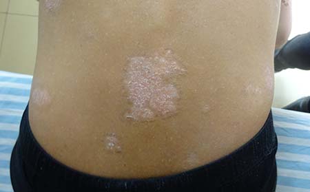 牛皮癬癥狀表現,牛皮癬發病什么癥狀