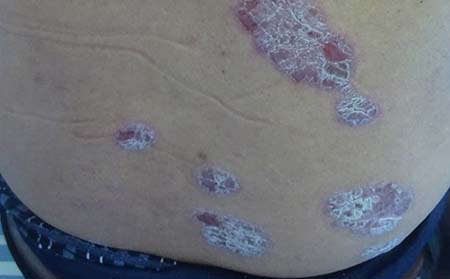 尋常型銀屑病常識(shí),什么是尋常型銀屑病