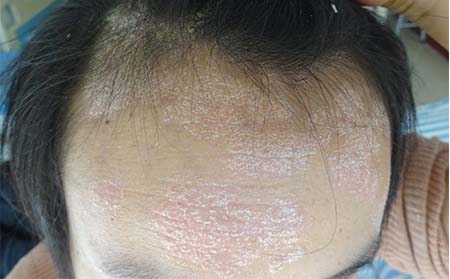 怎樣防治銀屑病,防治銀屑病辦法