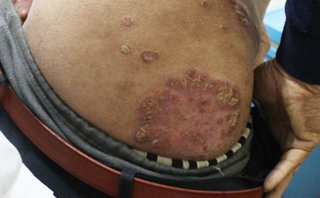 銀屑病初期治療,初期銀屑病控制治療