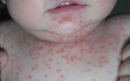 兒童銀屑病,兒童銀屑病多不多