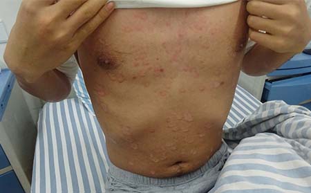 銀屑病治療費用,治銀屑病多少錢