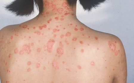 女性牛皮癬防治,怎樣防治女性牛皮癬