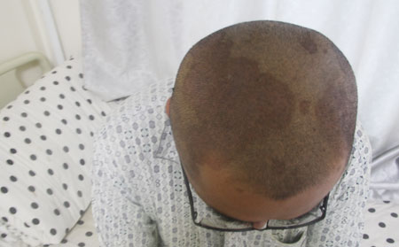 牛皮癬癥狀圖片,長牛皮癬癥狀表現