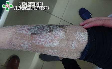 兒童牛皮癬癥狀,兒童長牛皮癬什么樣