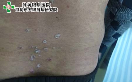 牛皮癬癥狀,牛皮癬初期癥狀表現