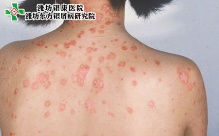 兒童牛皮癬傳染,牛皮癬有牛皮癬傳染嗎