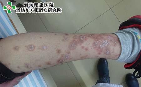 銀屑病初期治療,初期銀屑病怎樣治