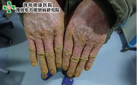 關節型牛皮癬常識,關節型牛皮癬什么樣